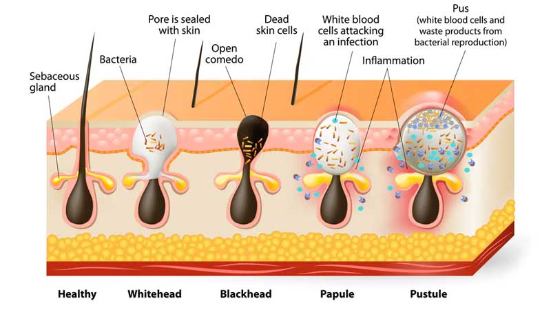 explain types of acne 